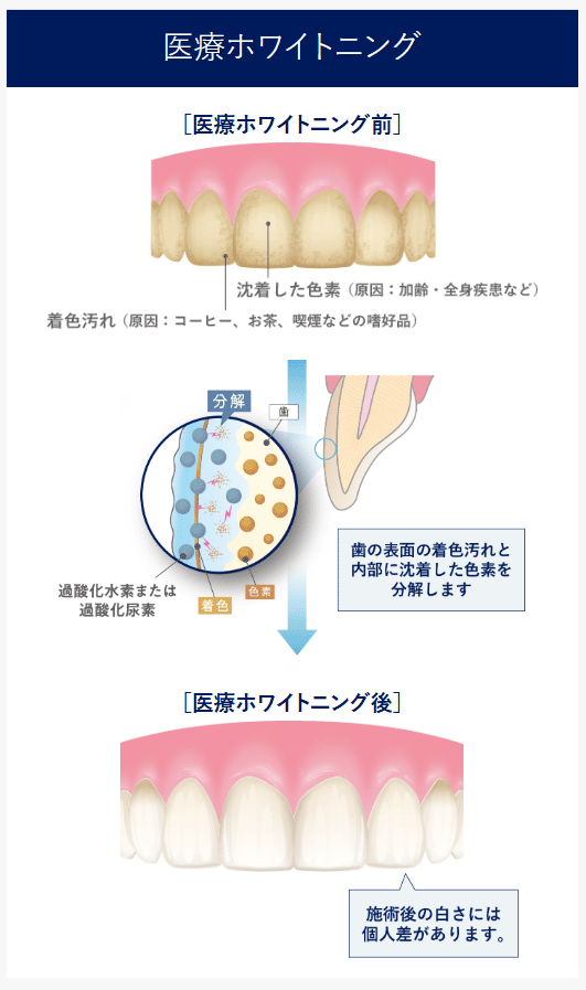 医療ホワイトニング
